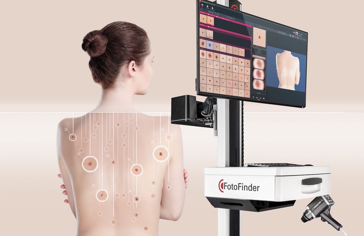 FotoFinder AI Mole Mapping